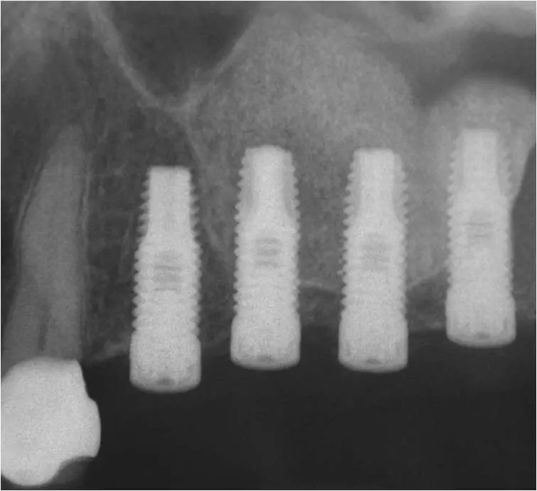 Lift Northern Kentucky Endodontics