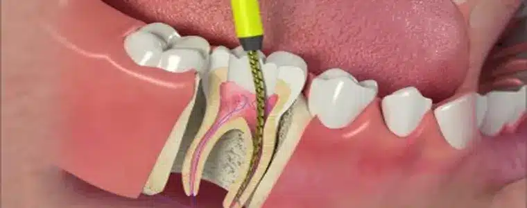 RCT - Root Canal