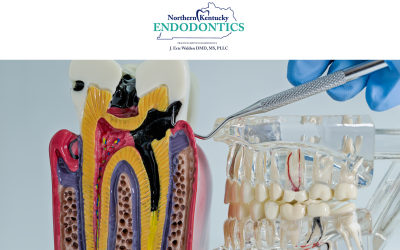 How to Tell If You Need a Root Canal: Signs and Symptoms