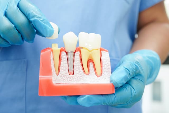 What Procedures Endodontist Perform