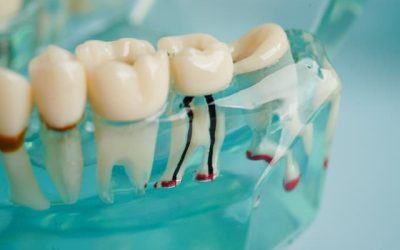 Understanding Root Canal Therapy: Saving Your Natural Teeth