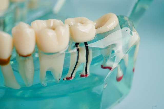 Understanding Root Canal Therapy: Saving Your Natural Teeth