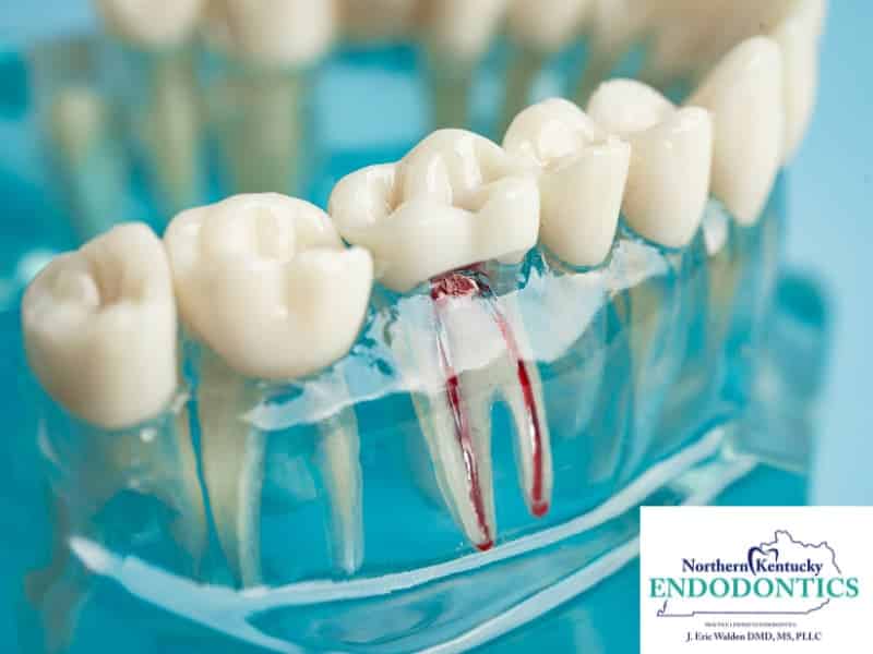 Understanding Endodontics: Your Guide to Root Canal Treatments