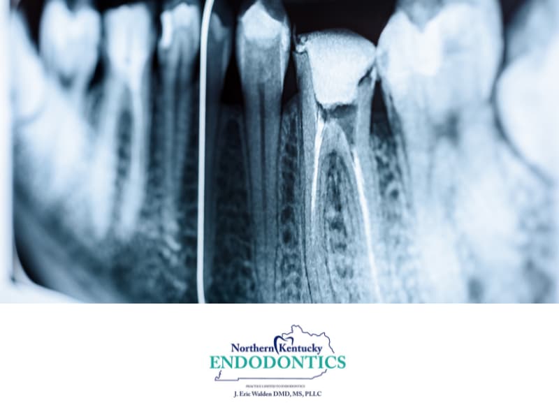 The Essential Guide to Endodontics: Your Path to Dental Health at Kentucky Endodontics