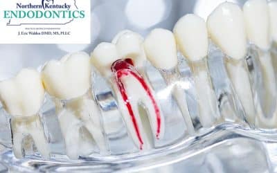 I Need a Root Canal and I Am Worried: What You Need to Know