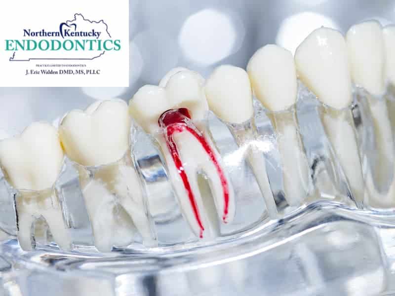 I Need a Root Canal and I Am Worried: What You Need to Know