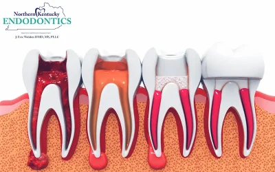 Blog 3 How Root Canal Treatment May Improve Health — Including Lowering Blood Sugar Levels