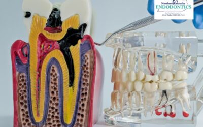 Debunking Root Canal Myths: Separating Fact from Fiction