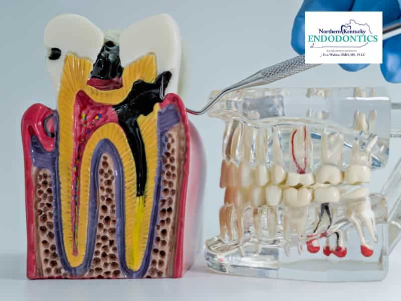 Debunking Root Canal Myths: Separating Fact from Fiction